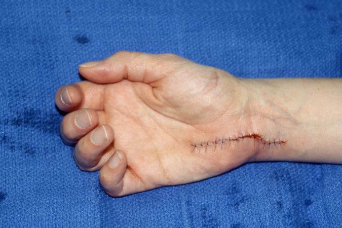 ULNAR ENTRAPMENT GUYON S Hand Surgery Source