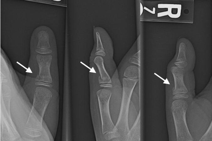 buckle fracture thumb