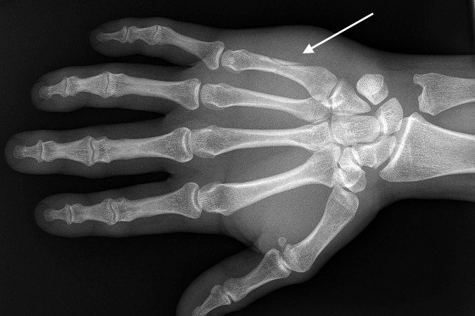 spiral fracture causes