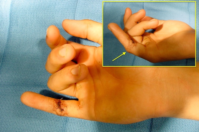 FLEXOR TENDON LACERATION | Hand Surgery Source