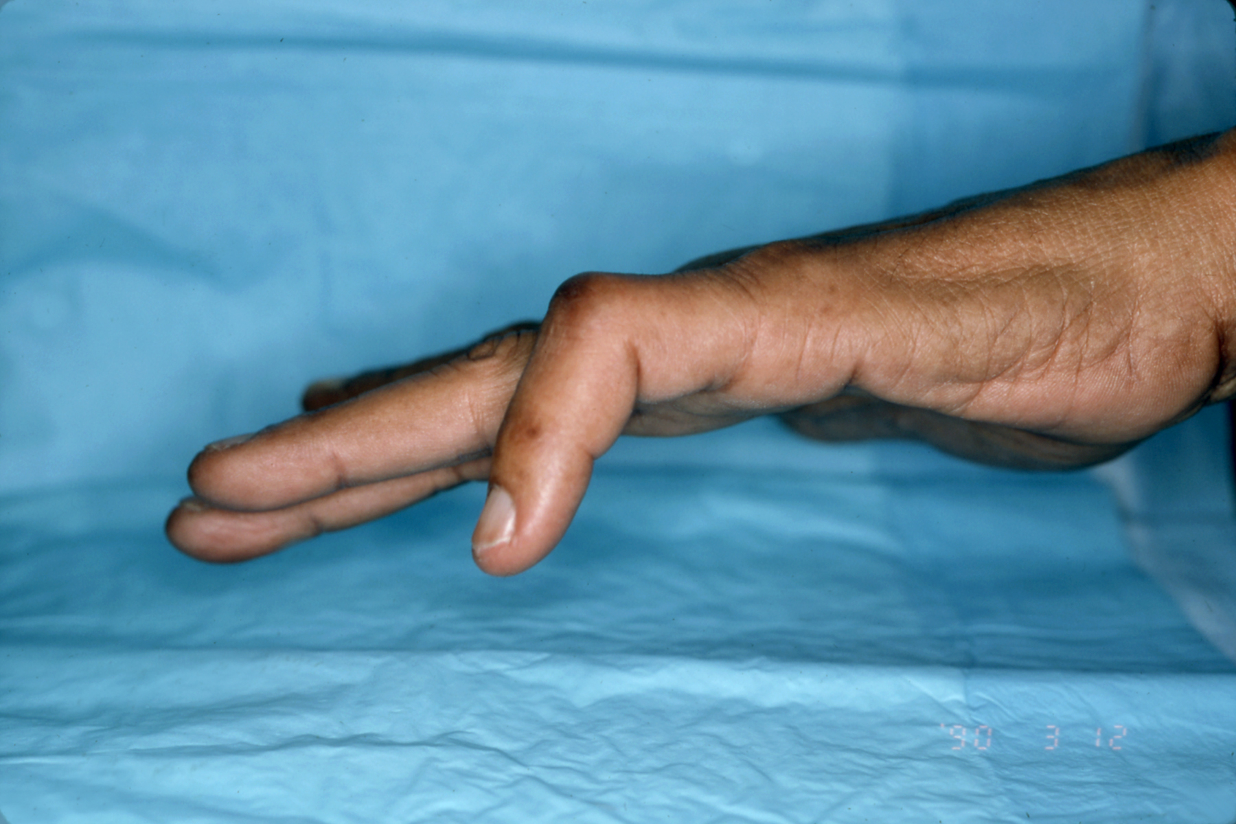 boutonniere-deformity-hand-surgery-source