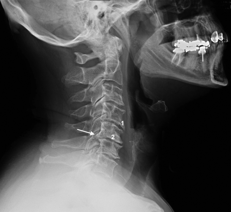 x ray of cervical spine arthritis