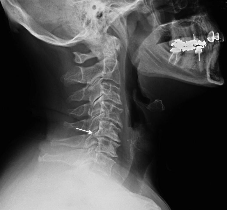 cervical spine nerves impingement x ray