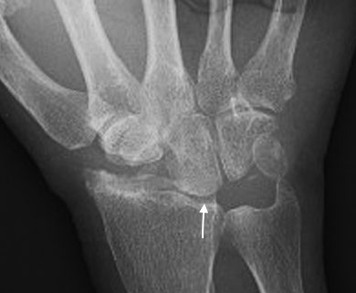 WRIST OSTEOARTHRITIS (Scaphoid Nonunion Advanced Collapse) | Hand ...