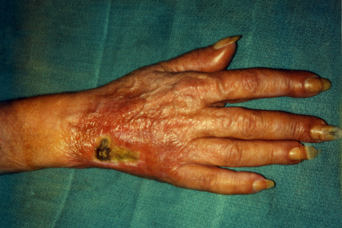 Neglected subcutaneous chemotherapy extravasation with secondary cellulitis.