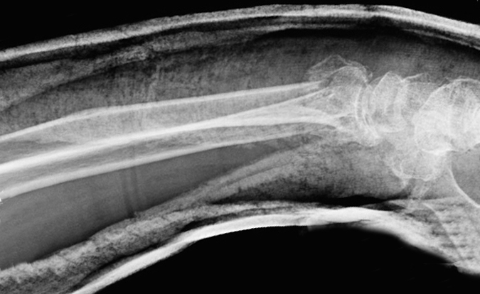 FRACTURE, COLLES' | Hand Surgery Source