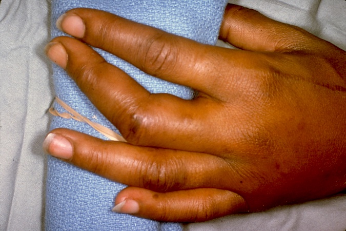 DISLOCATION, FINGER PROXIMAL INTERPHALANGEAL (PIP) JOINT | Hand Surgery ...