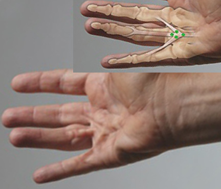 DUPUYTREN'S DISEASE | Hand Surgery Source