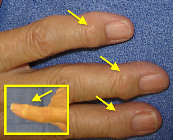 Osteoarthritis Nodules On Finger Joints