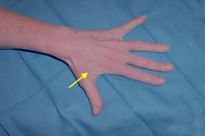 Ulnar Entrapment Guyons Hand Surgery Source