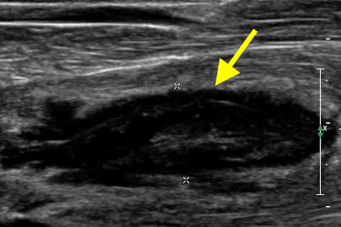 ultrasound consistent with abscess in proximal volar forearm