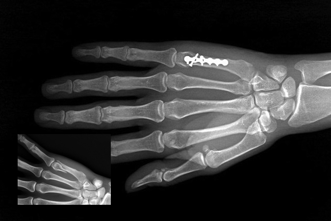 5th metacarpal fracture surgery