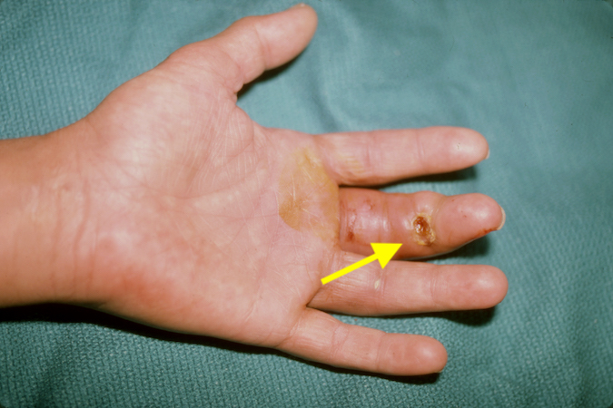 Injection injury (arrow) 36 hours after accident with power washer.  Note finger swelling.