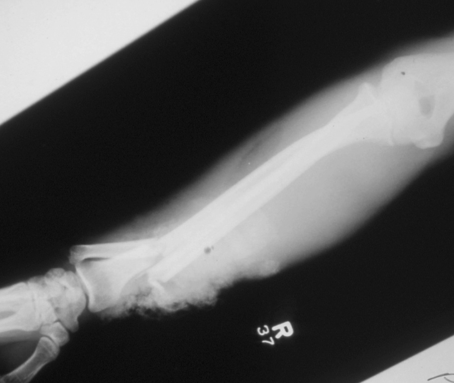 Lateral X-ray of right open distal -third transverse radius and ulna fractures 