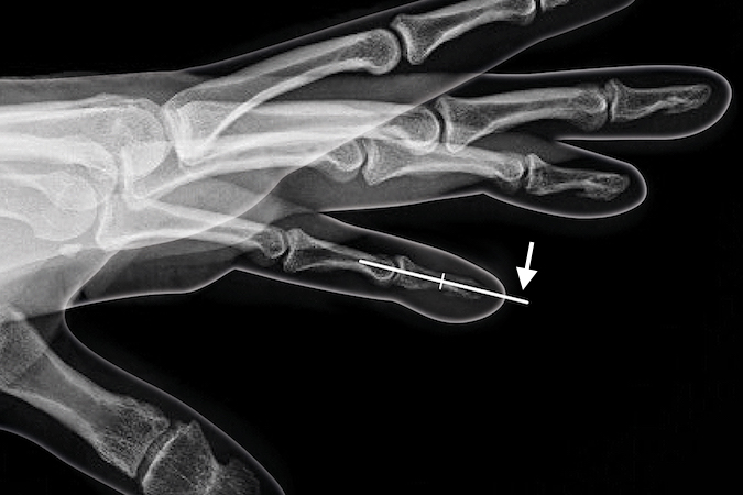 KIRNER'S DEFORMITY | Hand Surgery Source