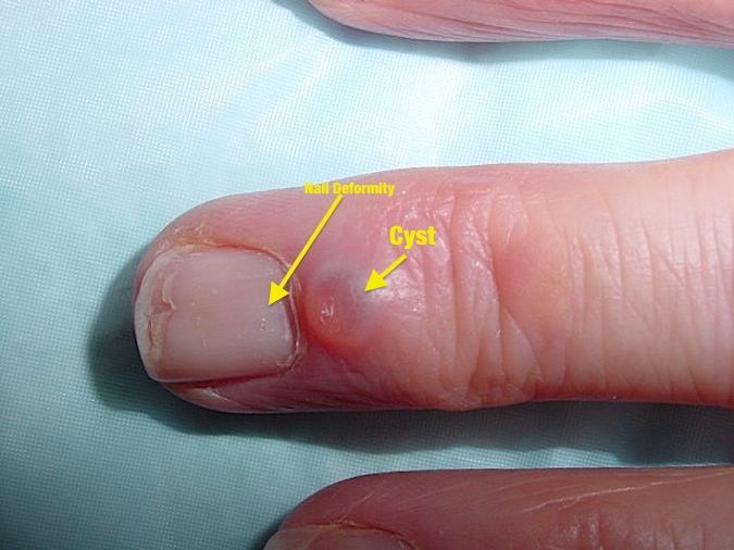 warm compress for cyst on finger