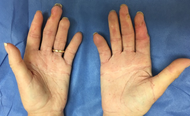 SYSTEMIC SCLEROSIS / SCLERODERMA (CREST) | Hand Surgery Source