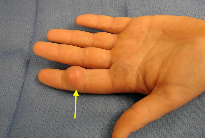 Sebaceous Cyst Hand Surgery Source - vrogue.co