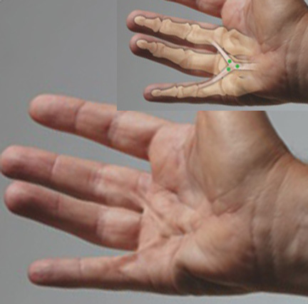 DUPUYTREN'S DISEASE | Hand Surgery Source