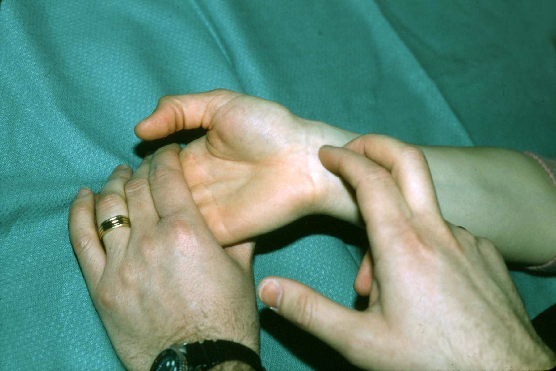 TINEL'S SIGN MEDIAN NERVE - This test is done by tapping on the median nerve just proximal to the wrist crease. The wrist is held in 30 degrees of dorsiflexion while the nerve is percussed. The wrist should be held loosely so that the patient doesn't tighten his volar ligaments and muscles during the test.