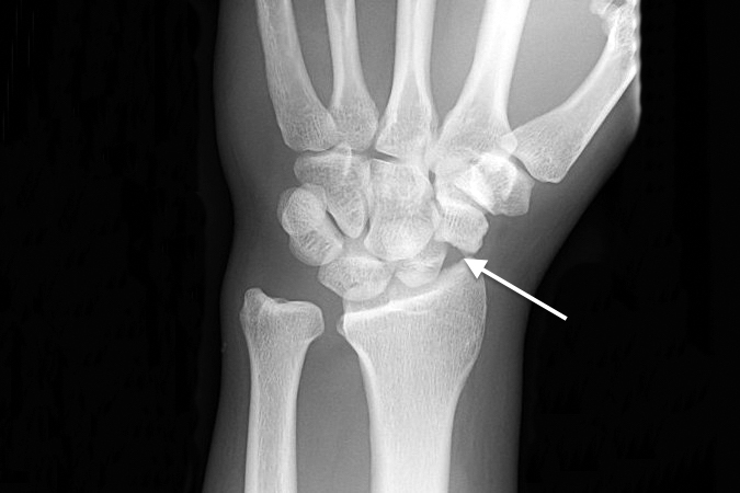 closed fracture and dislocation